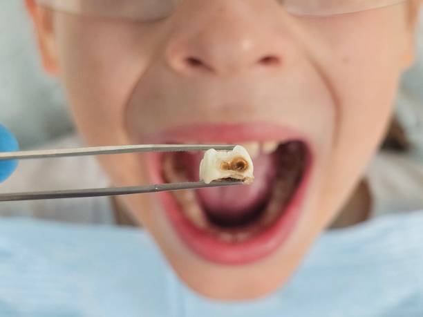 Best Emergency Dentist for Lost Fillings or Crowns in St Michaels, MD